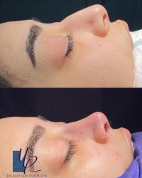 جراحی-بینی-100