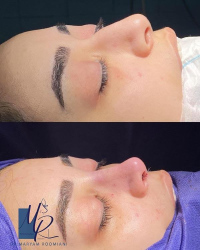 جراحی-بینی-102