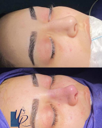 جراحی-بینی-103