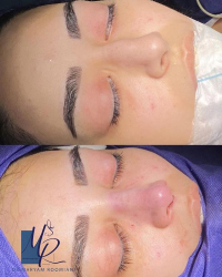 جراحی-بینی-104