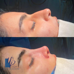 جراحی-بینی-107