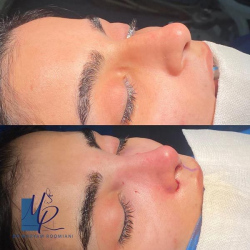 جراحی-بینی-108