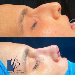 جراحی-بینی-109