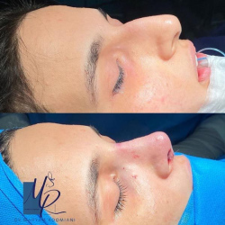 جراحی-بینی-110