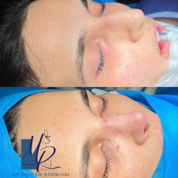 جراحی-بینی-111