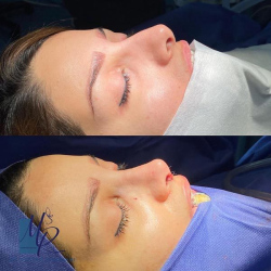 جراحی-بینی-113