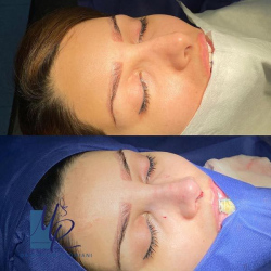 جراحی-بینی-114