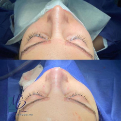 جراحی-بینی-115