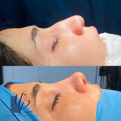 جراحی-بینی-117