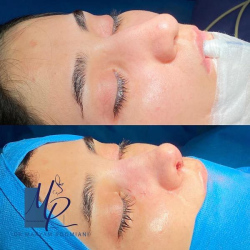 جراحی-بینی-118