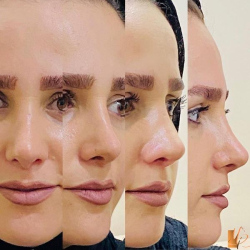 جراحی-بینی-119