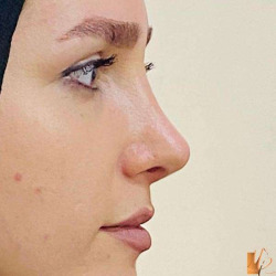 جراحی-بینی-120