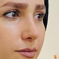 جراحی-بینی-121