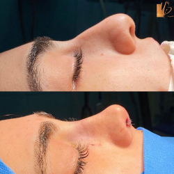 جراحی-بینی-124