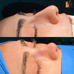 جراحی-بینی-125