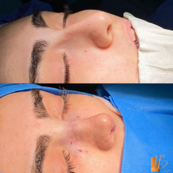 جراحی-بینی-126