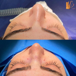 جراحی-بینی-127