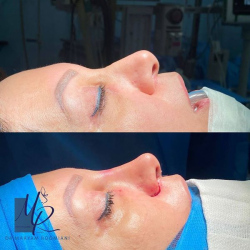 جراحی-بینی-128