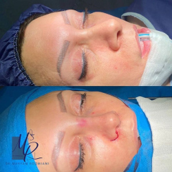 جراحی-بینی-129