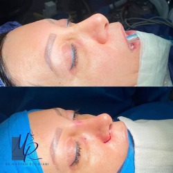 جراحی-بینی-130
