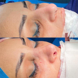 جراحی-بینی-38