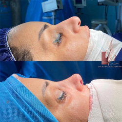 جراحی-بینی-39