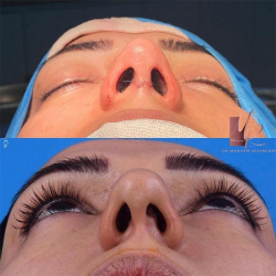 جراحی-بینی-40