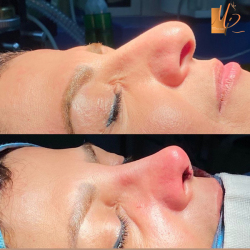 جراحی-بینی-41