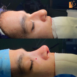 جراحی-بینی-42