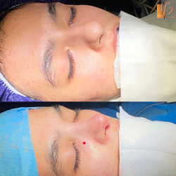 جراحی-بینی-43