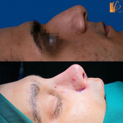 جراحی-بینی-44