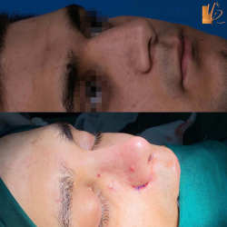 جراحی-بینی-45