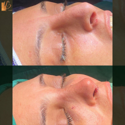 جراحی-بینی-51