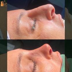 جراحی-بینی-52