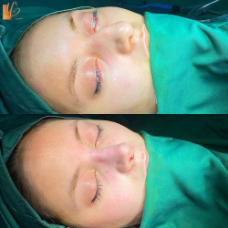 جراحی-بینی-53
