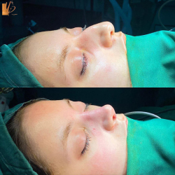جراحی-بینی-54
