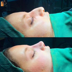 جراحی-بینی-55