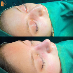 جراحی-بینی-56