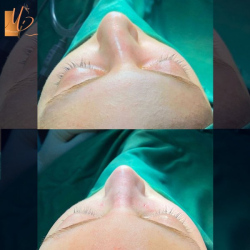 جراحی-بینی-57