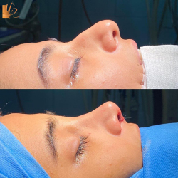 جراحی-بینی-59