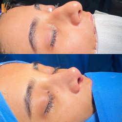 جراحی-بینی-60