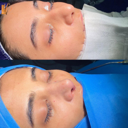 جراحی-بینی-61