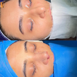 جراحی-بینی-62