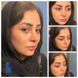 جراحی-بینی-63