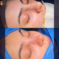 جراحی-بینی-64