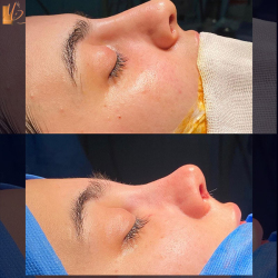 جراحی-بینی-65