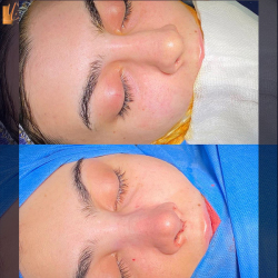 جراحی-بینی-66