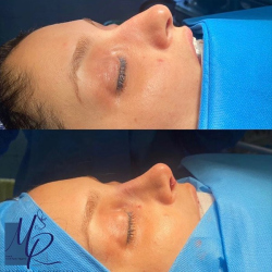 جراحی-بینی-67