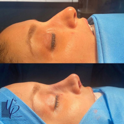 جراحی-بینی-68