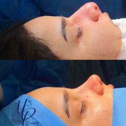 جراحی-بینی-69
